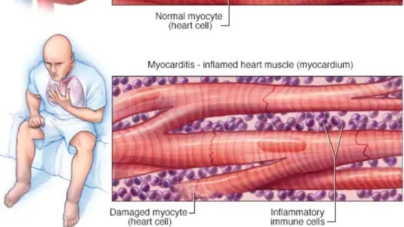 nhom nguoi nao de mac viem co tim sau tiem vaccine covid19