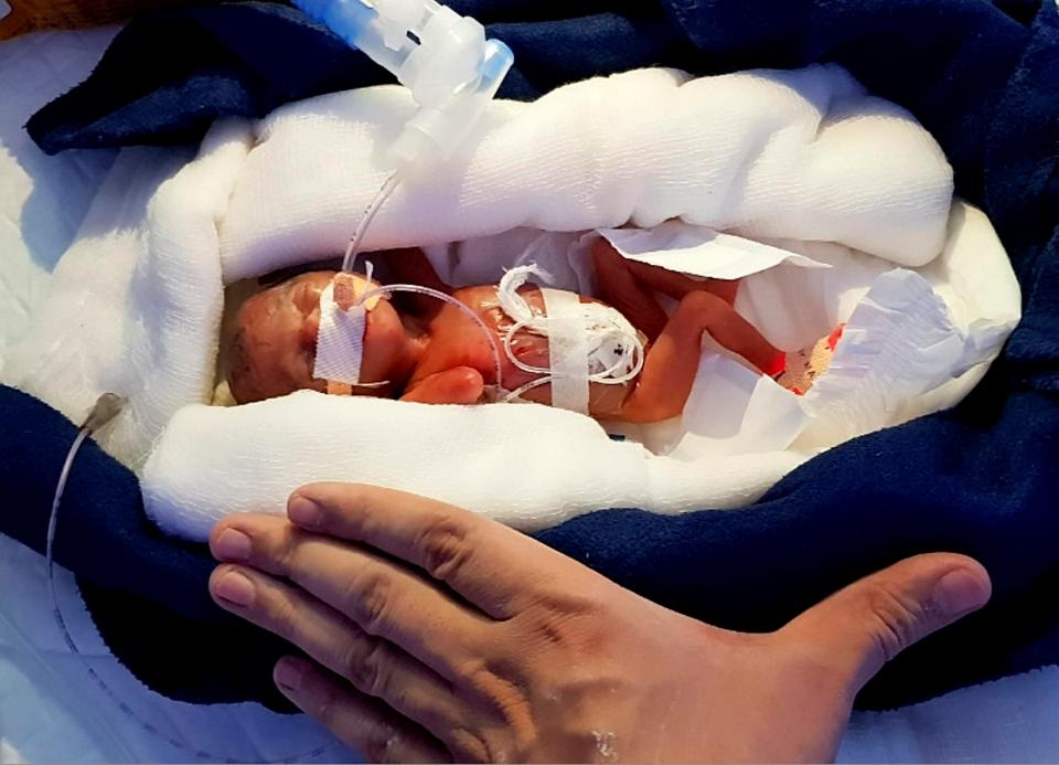 sinh non o tuan thai thu 28 be gai song sot than ky