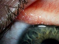 thanh nien o yen bai nhiem giun dai toi 60cm o bap tay