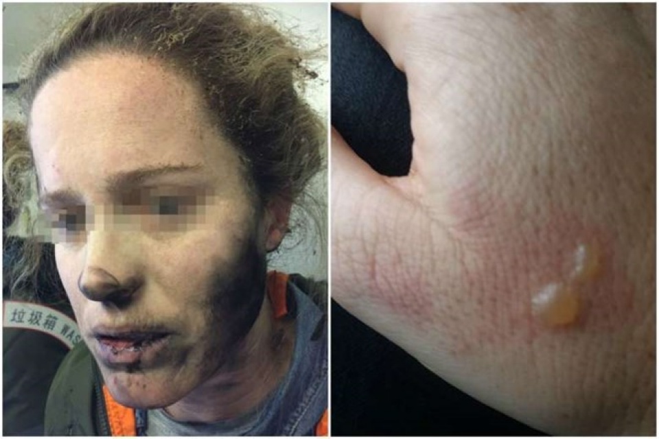 tai nghe no tren may bay nu hanh khach bi chay den mat