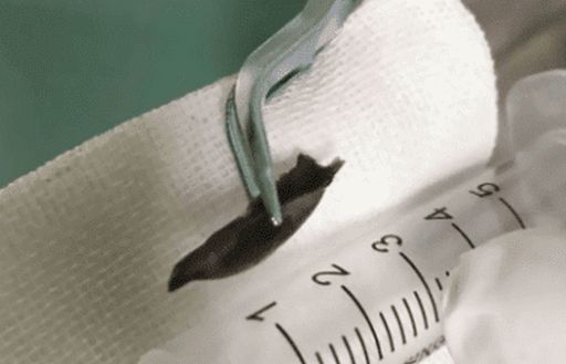 Chuyện lạ: Ho dai dẳng 14 năm vì... hóc xương