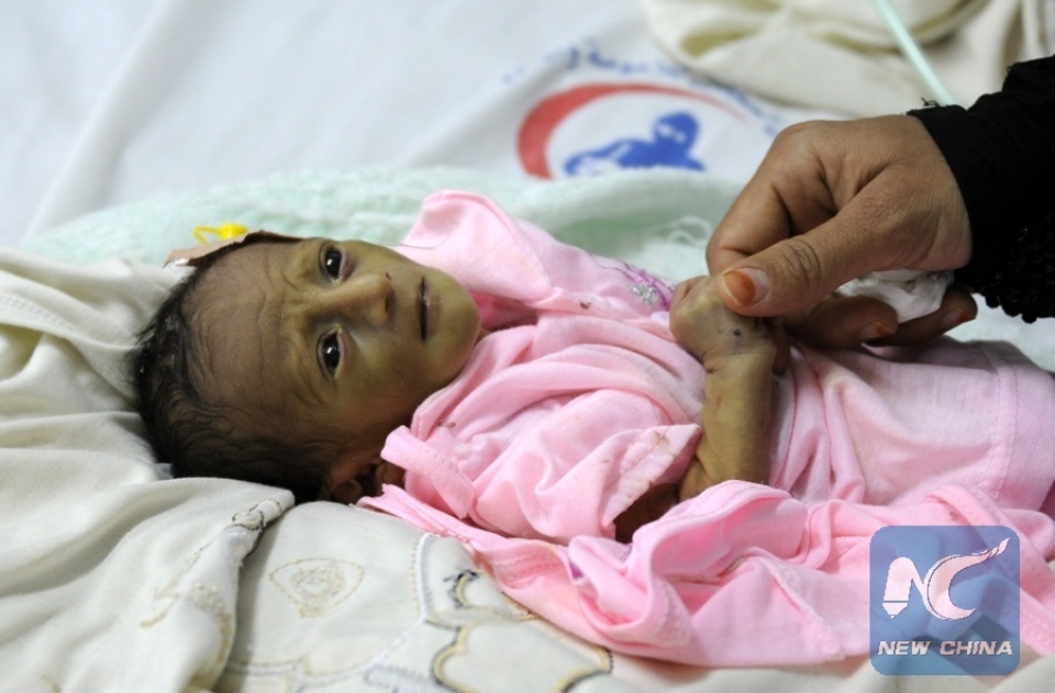 canh bao nguy co hon 1 trieu tre em mac benh ta o yemen