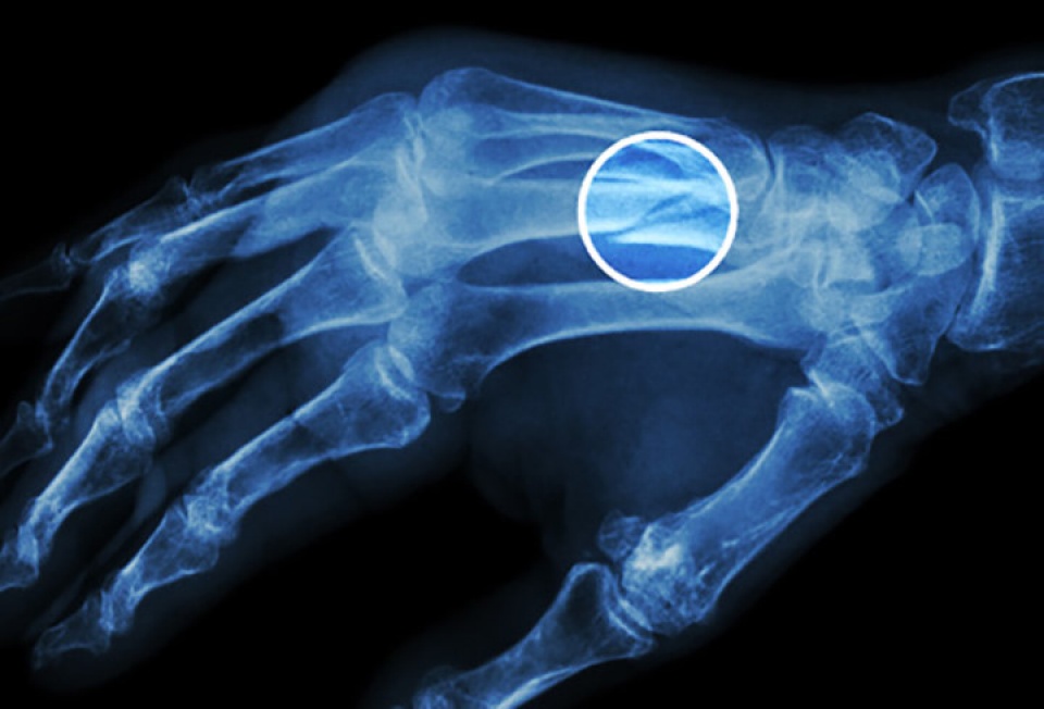 nhung benh nguoi cao tuoi thuong mac