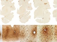 co the phat hien benh parkinson qua nuoc mat