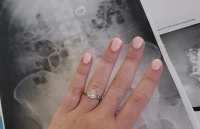 Lo bị mất cắp, cô dâu nuốt nhẫn kim cương khi ngủ mơ