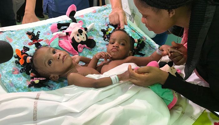 tach roi thanh cong cap be song sinh dinh lien nguoi cameroon