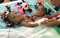 Tách rời thành công cặp bé song sinh dính liền người Cameroon