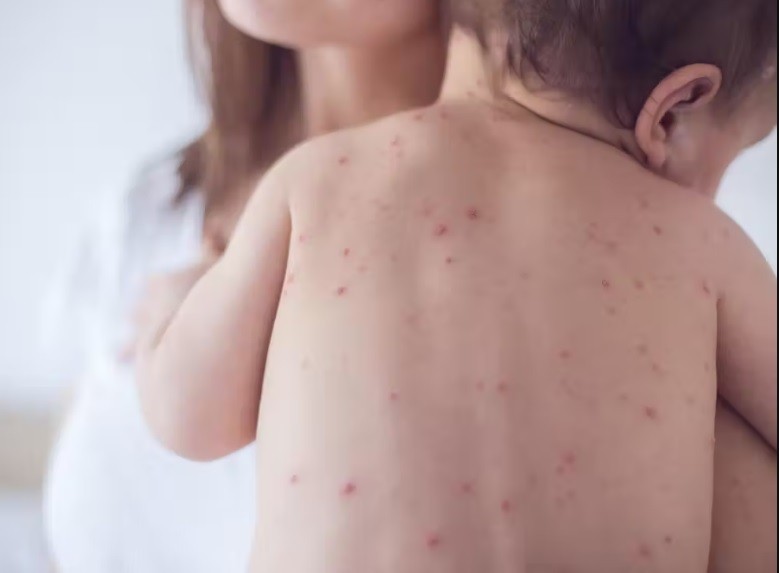 Dịch sởi, bệnh sởi ở trẻ em. (Nguồn: istock) Dịch sởi, bệnh sởi ở trẻ em. (Nguồn: istock)