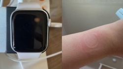 Đồng hồ giá rẻ của Apple khiến người dùng bị bỏng do quá tải nhiệt