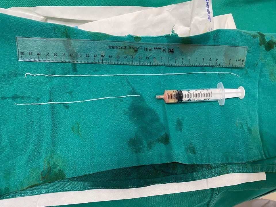 Thanh niên ở Yên Bái nhiễm giun dài tới 60cm ở bắp tay thanh nien o yen bai nhiem giun dai toi 60cm o bap tay