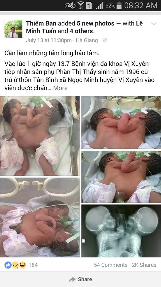 Tặng bằng khen cho bác sĩ quyên góp tiền cứu 2 bé song sinh dính liền tang bang khen cho bac si quyen gop tien cuu 2 be song sinh dinh lien