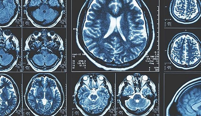 Người có đột biến hiếm gặp gần như chắc chắn mắc bệnh Parkinson cac nha nghien cuu phat hien ra nhung dau hieu som nhat cua benh parkinson trong nao