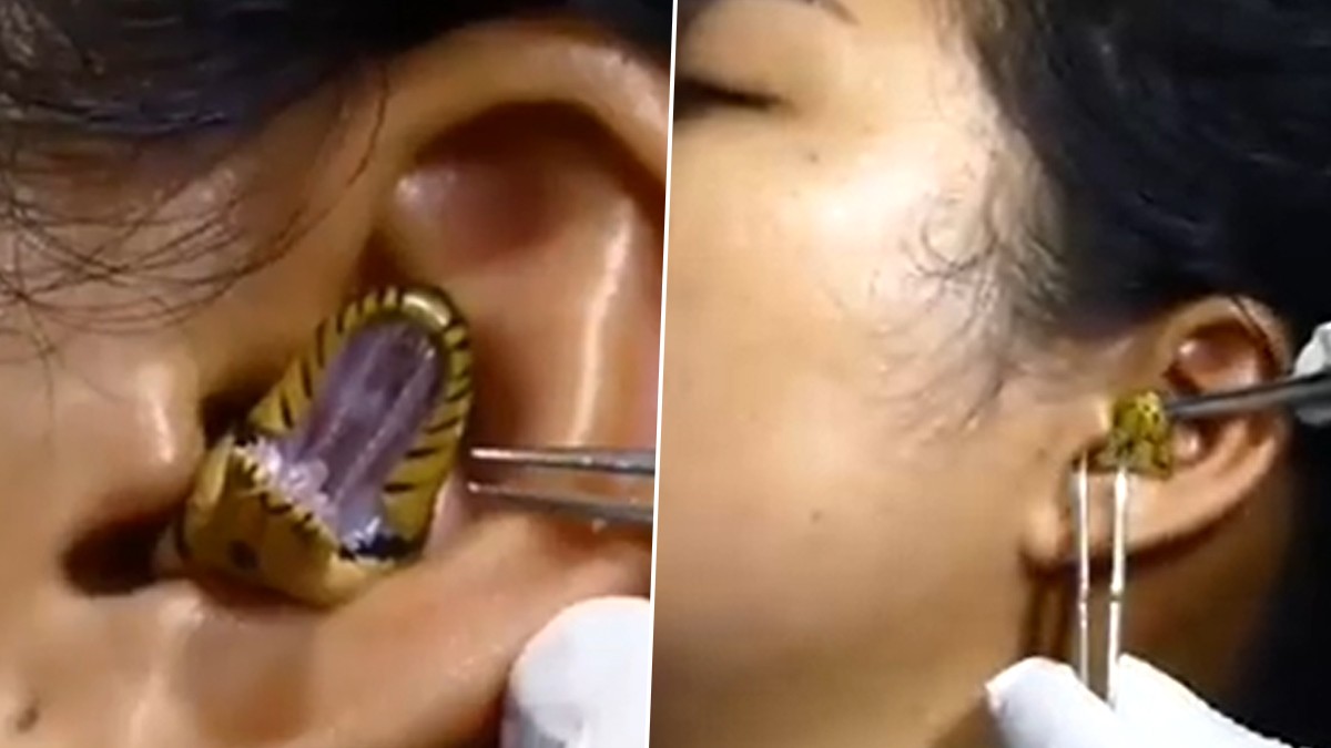 Video gây 'sốc' khi bác sĩ tìm cách gắp con rắn sống ra khỏi tai người phụ nữ Ấn Độ
